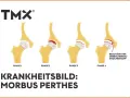 Illustration von 4 Phasen des Morbus Perthes am Hüftgelenk.