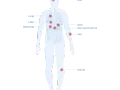 Morbus Crohn: Diese Medikamente unbedingt meiden (Ärzte-Tipps)