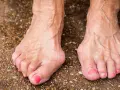 Füße mit Hallux Valgus, eine mögliche Hallux Ursache ist die genetische Veranlagung. Die Zehen sind deformiert.