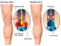 Bein Thrombose Symptome: Warnsignale erkennen & richtig handeln