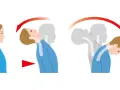 Illustration zeigt die Bewegung des Kopfes bei einem Schleudertrauma.