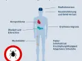Borreliose Symptome: So erkennen Sie die Anzeichen einer Zeckeninfektion