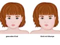 Mumps-Symptome: Erkennen, Verlauf & Komplikationen | Was tun?