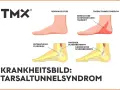 Vergleich Fuß: Normal vs. Tarsaltunnelsyndrom. Ursachen: Nervenkompression im Tarsaltunnel.