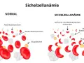 Sichelzellanämie Diagnose: Labor, Tests & Gentest erklärt