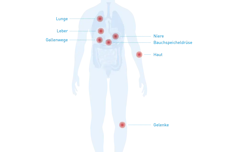 Morbus Crohn: Diese Medikamente unbedingt meiden (Ärzte-Tipps)