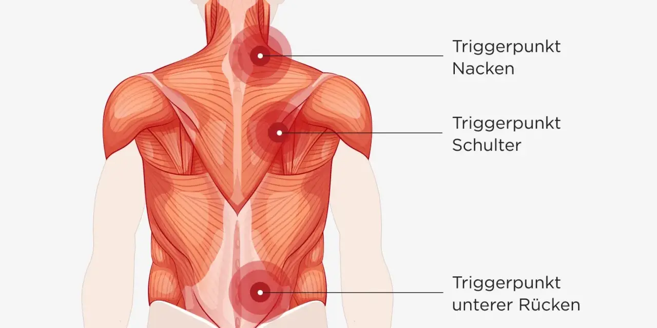 Rückenmuskulatur mit roten Markierungen für Triggerpunkte im Nacken, an der Schulter und im unteren Rücken. Muskel knoten können Schmerzen verursachen.