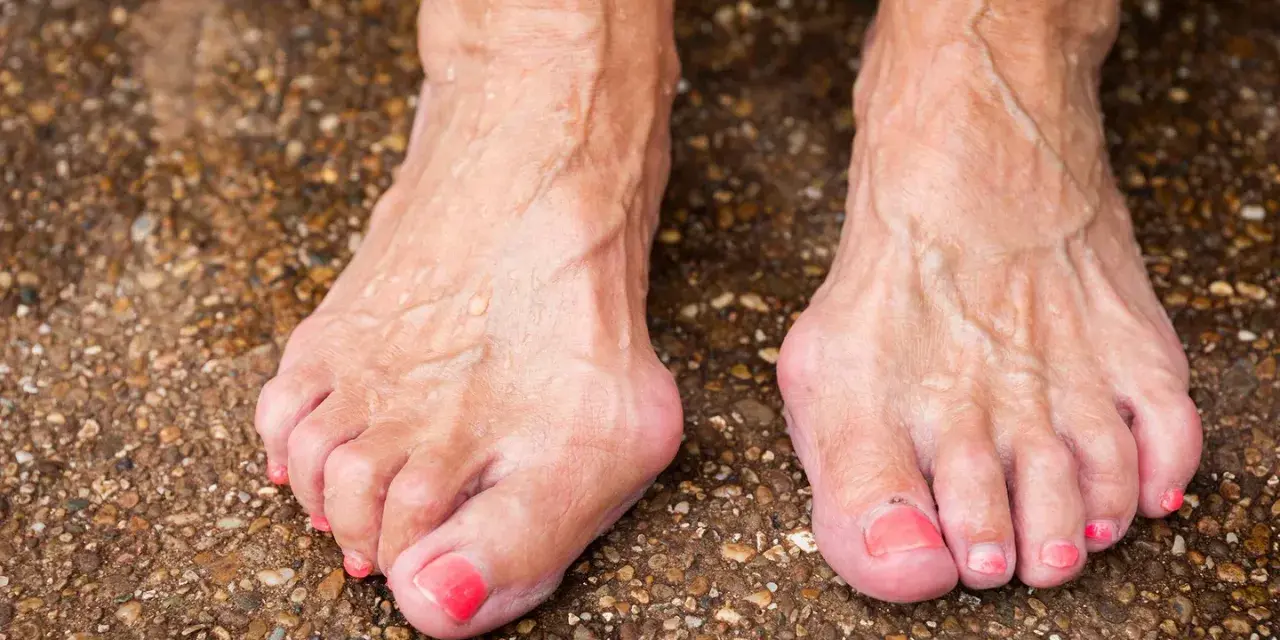 Füße mit Hallux Valgus, eine mögliche Hallux Ursache ist die genetische Veranlagung. Die Zehen sind deformiert.