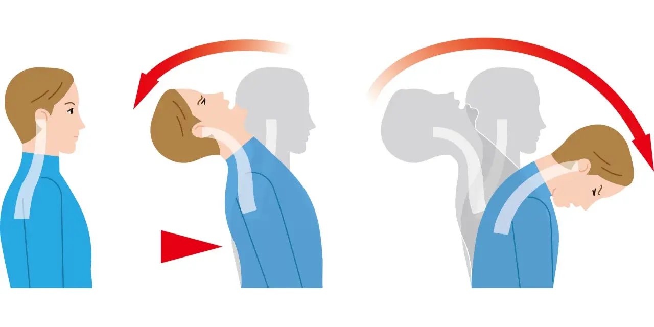Illustration zeigt die Bewegung des Kopfes bei einem Schleudertrauma.