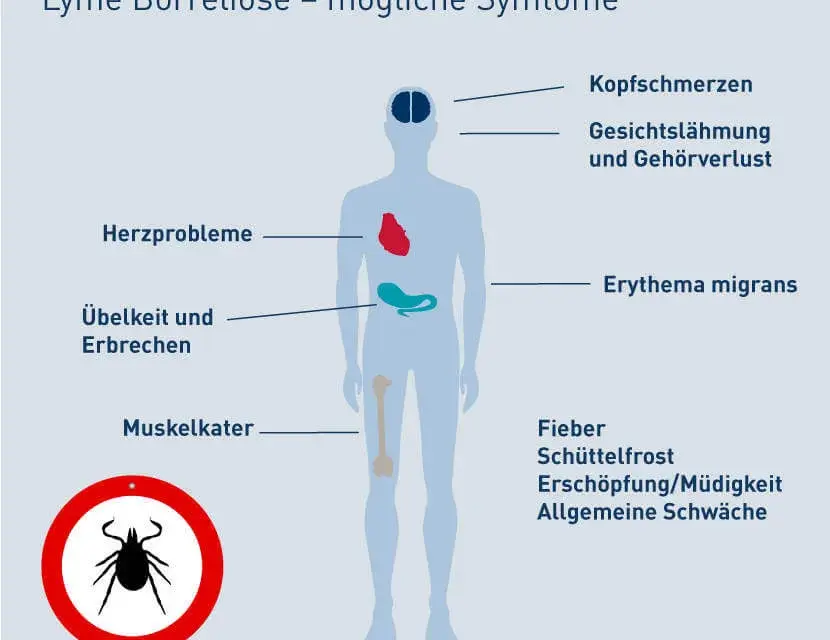 Borreliose Symptome: So erkennen Sie die Anzeichen einer Zeckeninfektion