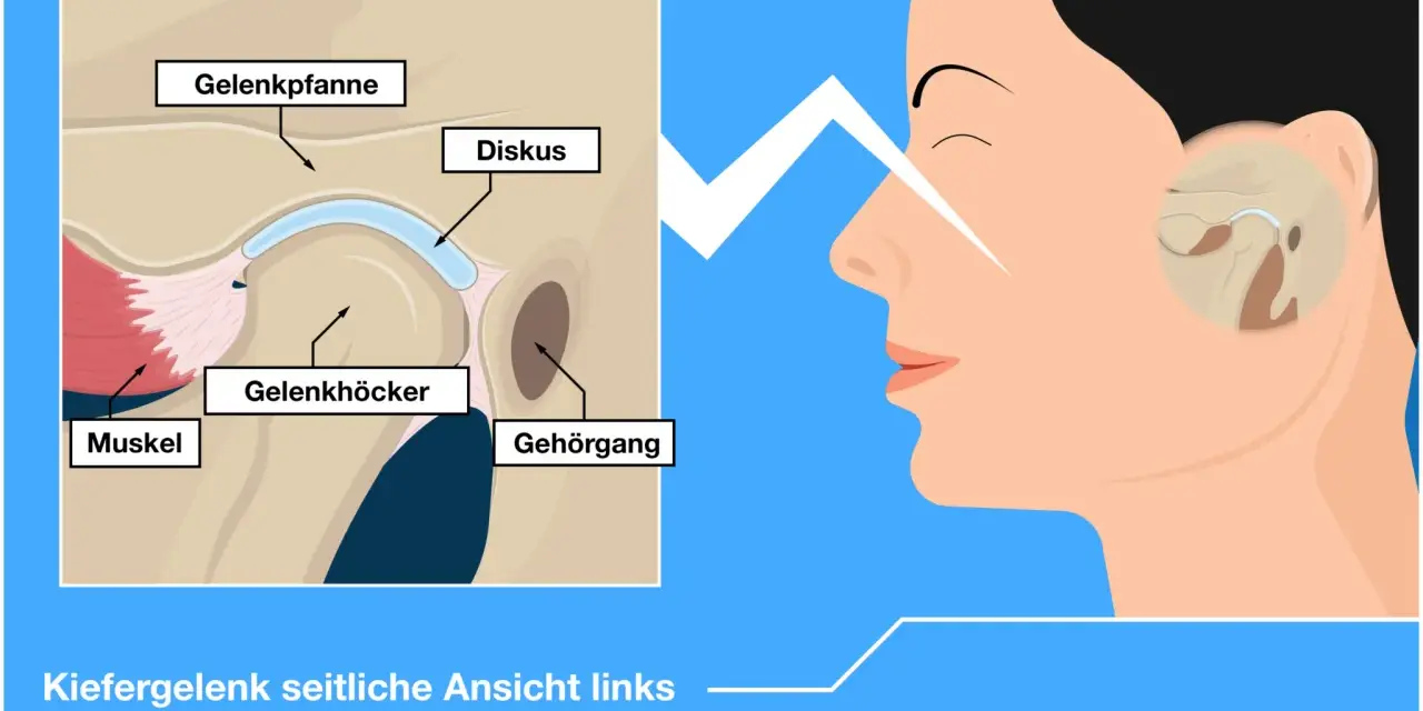 Detailansicht des Kiefergelenks mit Muskel, Gelenkpfanne, Gelenkhöcker und Diskus. Ein Blitz deutet auf Schmerzen durch einen verschobenen Wirbel hin.