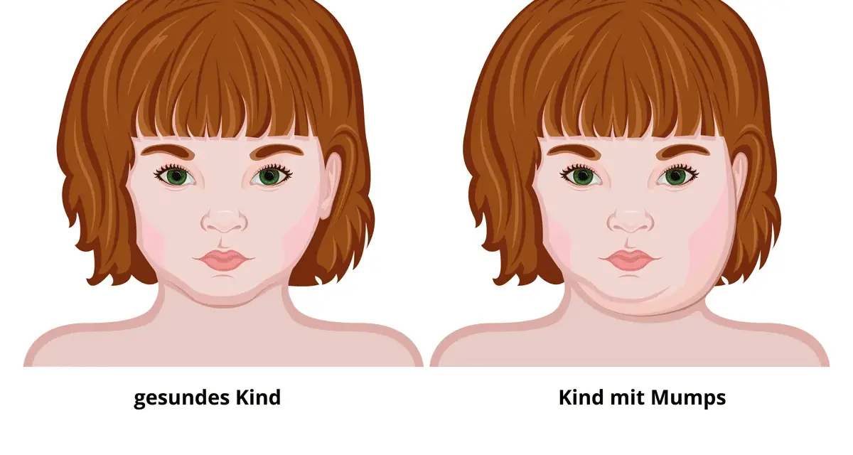 Mumps-Symptome: Erkennen, Verlauf & Komplikationen | Was tun?