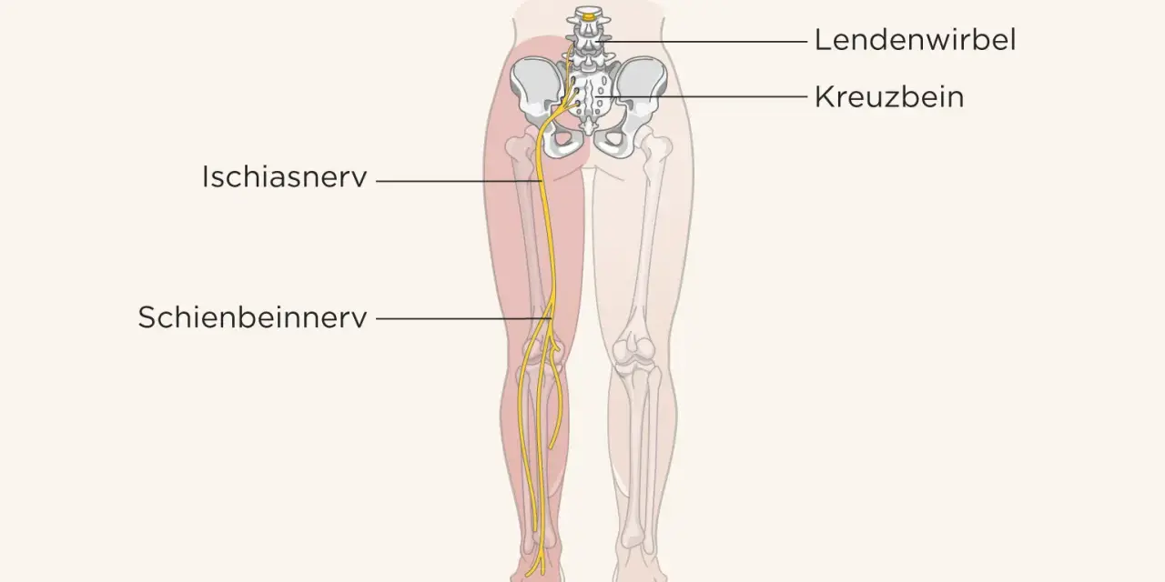Illustration zeigt den Ischiasnerv, der vom Lendenwirbelbereich über das Kreuzbein bis ins Bein verläuft. Eine Massage kann hier Linderung verschaffen.