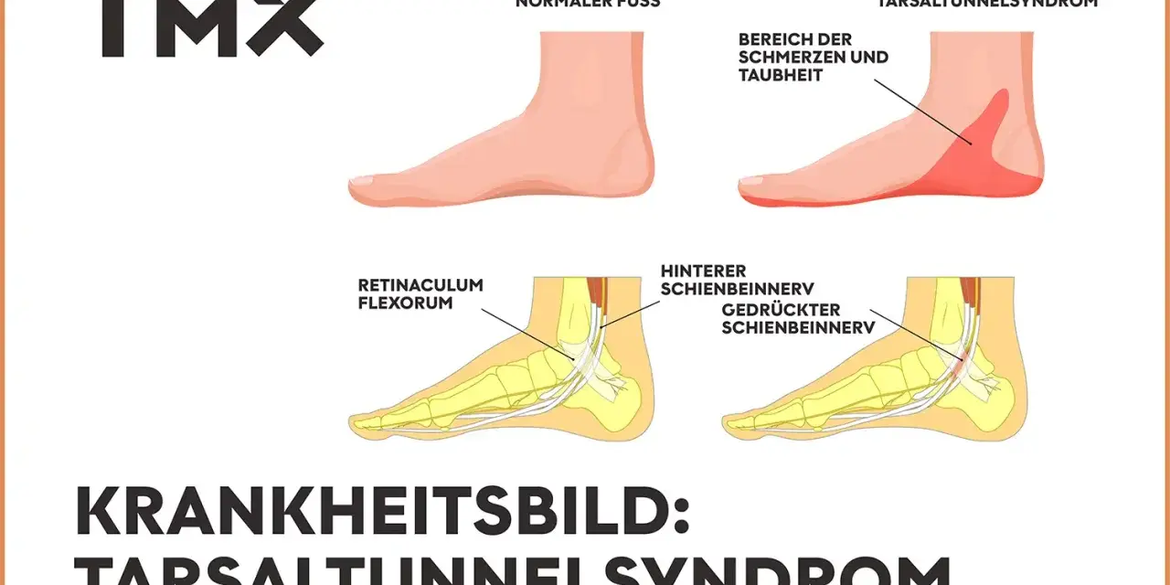 Vergleich Fuß: Normal vs. Tarsaltunnelsyndrom. Ursachen: Nervenkompression im Tarsaltunnel.