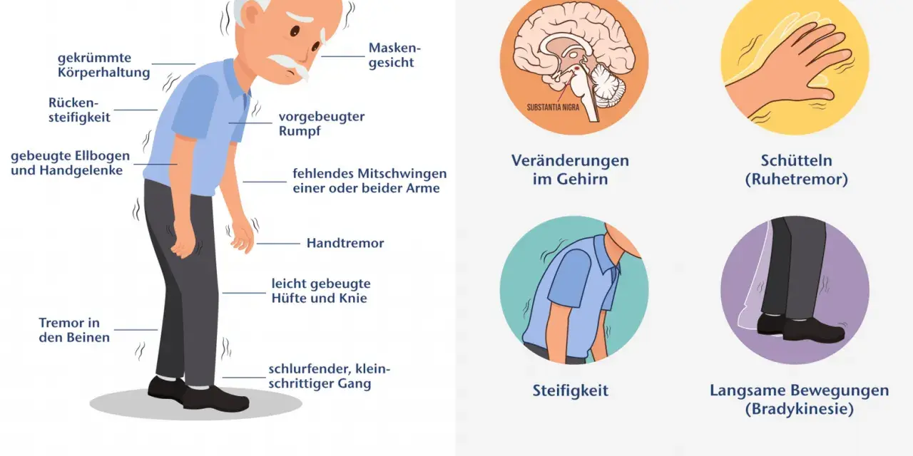Illustration von Parkinson-Symptomen: gebeugte Haltung, Tremor, Steifigkeit, Gehirn.