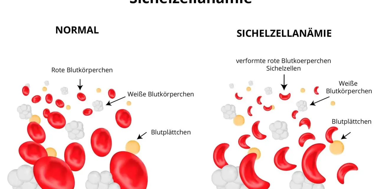 Sichelzellanämie Diagnose: Labor, Tests & Gentest erklärt