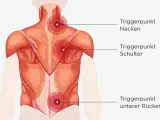 Rückenmuskulatur mit roten Markierungen für Triggerpunkte im Nacken, an der Schulter und im unteren Rücken. Muskel knoten können Schmerzen verursachen.