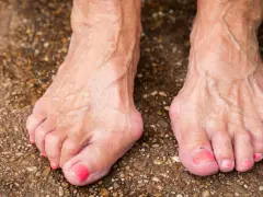 Füße mit Hallux Valgus, eine mögliche Hallux Ursache ist die genetische Veranlagung. Die Zehen sind deformiert.