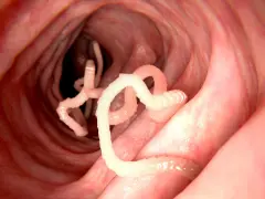 Würmer im Darm: Nahaufnahme von Parasiten, die sich in einem roten, schleimigen Darmwinden.