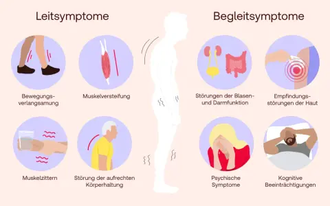 Illustration von Parkinson-Symptomen: Bewegungsverlangsamung, Muskelversteifung, Zittern, Haltungsstörung, Blasen-/Darmprobleme, Hautempfindungsstörungen, psychische und kognitive Probleme.