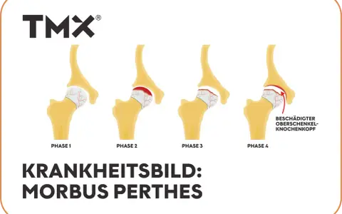 Illustration von 4 Phasen des Morbus Perthes am Hüftgelenk.