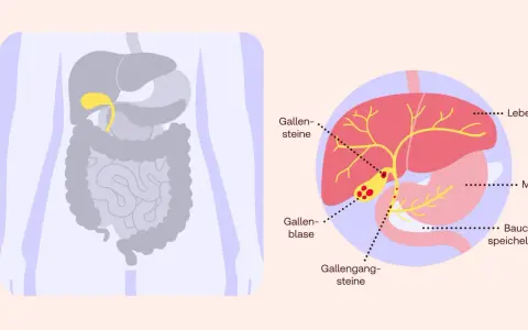 Gallensteine: Symptome erkennen & wann Sie handeln sollten