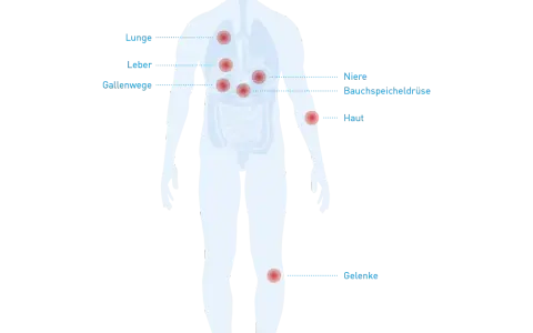 Morbus Crohn: Diese Medikamente unbedingt meiden (Ärzte-Tipps)