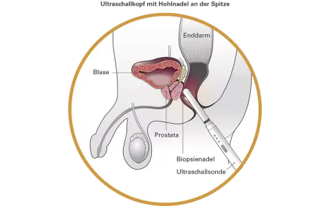 Prostata-Vorsorge ab 30: Wann ist sie wirklich nötig?