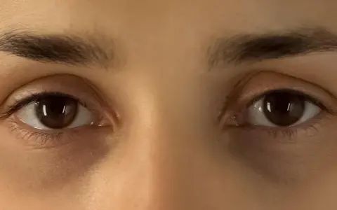 Nahaufnahme von Augen mit dunklen Ringen unter den Augen.
