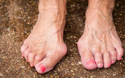 Füße mit Hallux Valgus, eine mögliche Hallux Ursache ist die genetische Veranlagung. Die Zehen sind deformiert.
