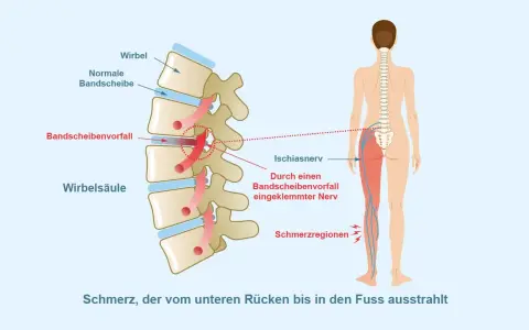 Illustration zeigt Bandscheibenvorfall, der Ischiasnerv reizt. Schmerz strahlt vom Rücken ins Bein aus. Mögliche Linderung durch Ischias Medikamente.