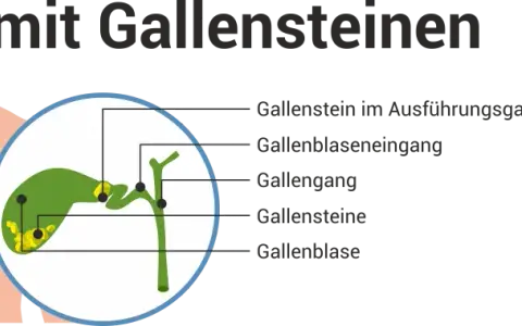 Verstopfte Gallengänge: Symptome erkennen & Ursachen verstehen