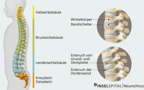 Illustration der Wirbelsäule mit Darstellung eines Wirbelbruchs. Mögliche wirbelbruch symptome werden durch die gezeigten Frakturen verdeutlicht.