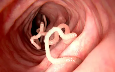 Würmer im Darm: Nahaufnahme von Parasiten, die sich in einem roten, schleimigen Darmwinden.