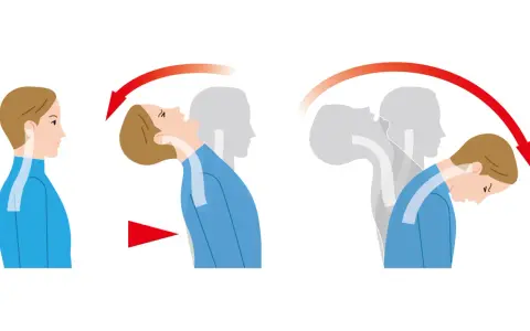 Illustration zeigt die Bewegung des Kopfes bei einem Schleudertrauma.