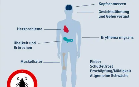 Borreliose Symptome: So erkennen Sie die Anzeichen einer Zeckeninfektion