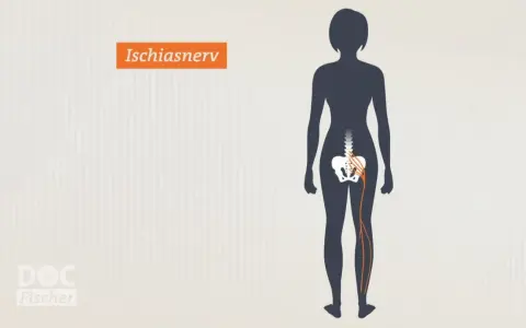 Illustration zeigt den Ischiasnerv, der vom Rückenmark bis ins Bein verläuft. Reizung kann zu Ischias Schmerz führen.