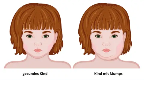 Mumps-Symptome: Erkennen, Verlauf & Komplikationen | Was tun?