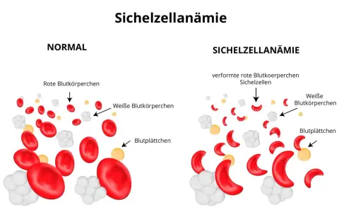 Sichelzellanämie Diagnose: Labor, Tests & Gentest erklärt