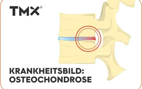 Darstellung eines Wirbels mit Bandscheibenschaden. Bei Osteochondrose wie geht es weiter? TMX Logo.