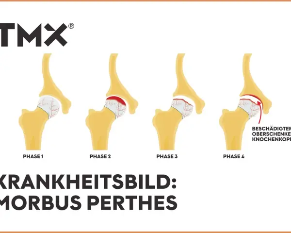Illustration von 4 Phasen des Morbus Perthes am Hüftgelenk.
