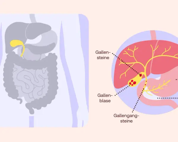 Gallensteine: Symptome erkennen & wann Sie handeln sollten