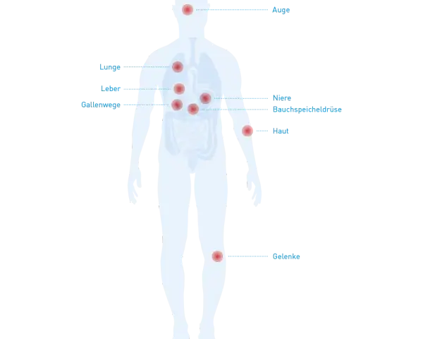 Morbus Crohn: Diese Medikamente unbedingt meiden (Ärzte-Tipps)