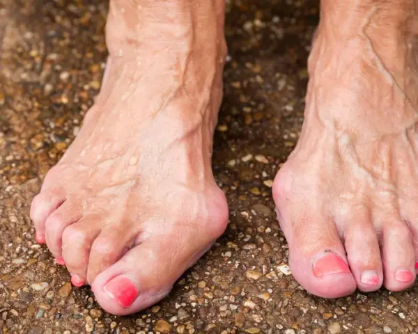 Füße mit Hallux Valgus, eine mögliche Hallux Ursache ist die genetische Veranlagung. Die Zehen sind deformiert.