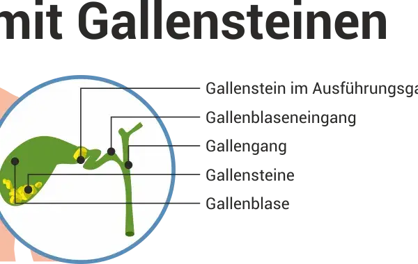 Verstopfte Gallengänge: Symptome erkennen & Ursachen verstehen