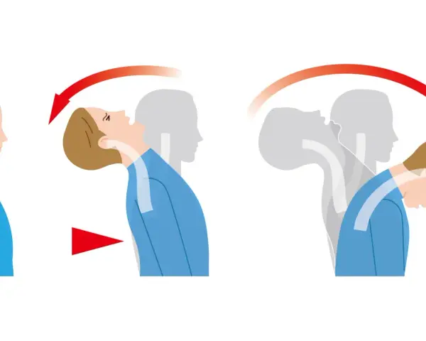 Illustration zeigt die Bewegung des Kopfes bei einem Schleudertrauma.