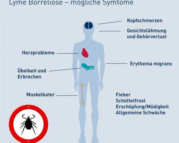 Borreliose Symptome: So erkennen Sie die Anzeichen einer Zeckeninfektion