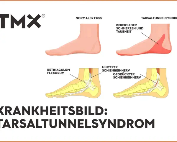 Vergleich Fuß: Normal vs. Tarsaltunnelsyndrom. Ursachen: Nervenkompression im Tarsaltunnel.