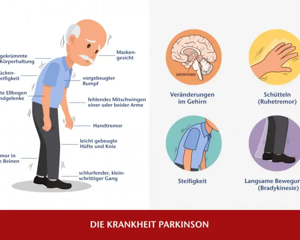 Illustration von Parkinson-Symptomen: gebeugte Haltung, Tremor, Steifigkeit, Gehirn.