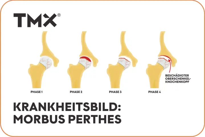 Illustration von 4 Phasen des Morbus Perthes am Hüftgelenk.